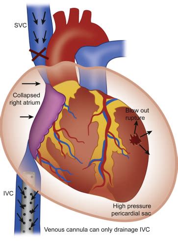 lv free wall|free wall rupture myocardial infarction.